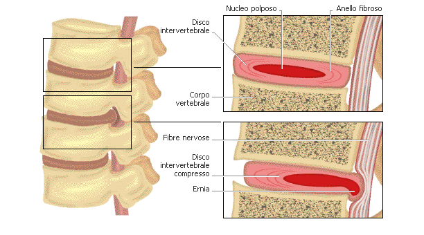 ernia-discale5